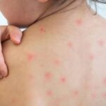 ২৪ ঘণ্টায় হামের উপসর্গ নিয়ে আরও ৪ জনের মৃত্যু