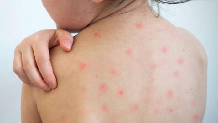 ২৪ ঘণ্টায় হামের উপসর্গ নিয়ে আরও ৪ জনের মৃত্যু