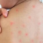 ২৪ ঘণ্টায় হাম ও এর উপসর্গে ৭ জনের মৃত্যু, আক্রান্ত সহস্রাধিক