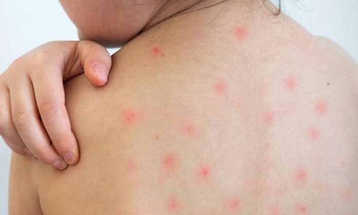 ২৪ ঘণ্টায় হাম ও এর উপসর্গে ৭ জনের মৃত্যু, আক্রান্ত সহস্রাধিক