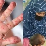 হামের উপসর্গ নিয়ে আরো ৪ শিশুর মৃত্যু, হাসপাতালে ভর্তি ১১৭৭