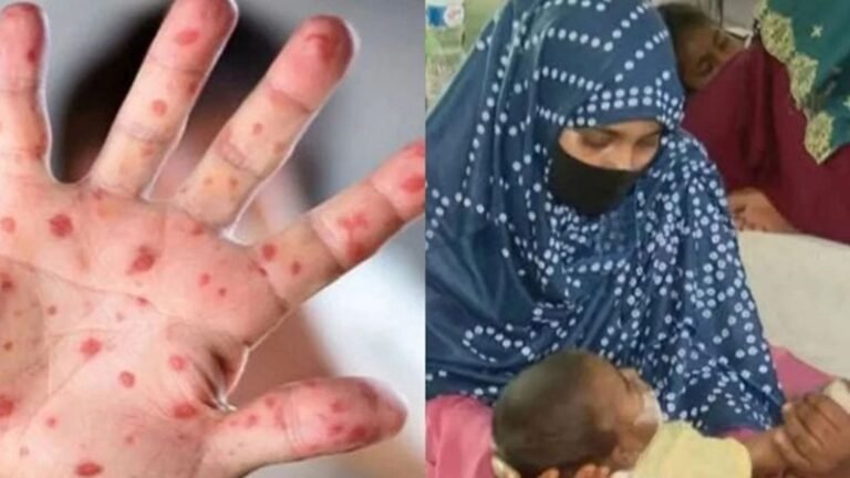 হামের উপসর্গ নিয়ে আরো ৪ শিশুর মৃত্যু, হাসপাতালে ভর্তি ১১৭৭