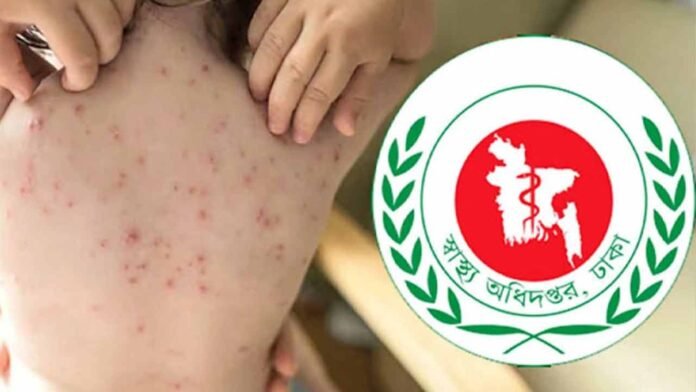 হাম ও হামের উপসর্গ নিয়ে আরও ৭ শিশুর মৃত্যু