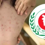 হামের প্রকোপে ২৪ ঘণ্টায় আরও ৯ জনের মৃত্যু