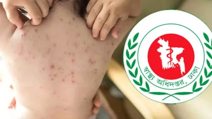 হামের প্রকোপে ২৪ ঘণ্টায় আরও ৯ জনের মৃত্যু