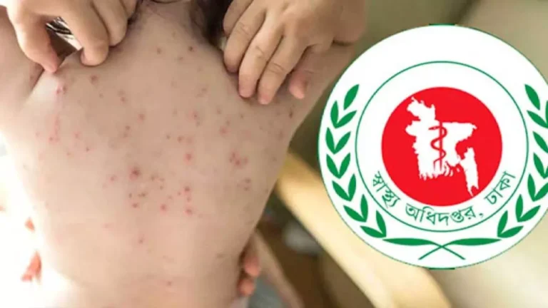 হামের প্রকোপে ২৪ ঘণ্টায় আরও ৯ জনের মৃত্যু