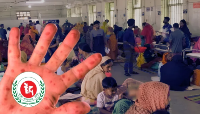 হাম ও উপসর্গে আরও ৪ শিশুর মৃত্যু, মোট মৃত্যু ৬০৫