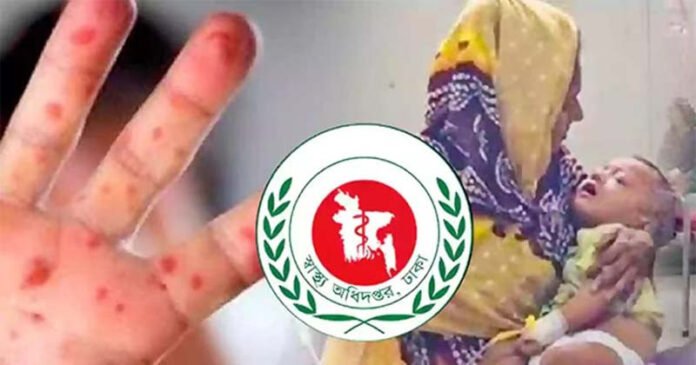 একদিনে হাম উপসর্গ নিয়ে আরও ৮ শিশুর মৃত্যু