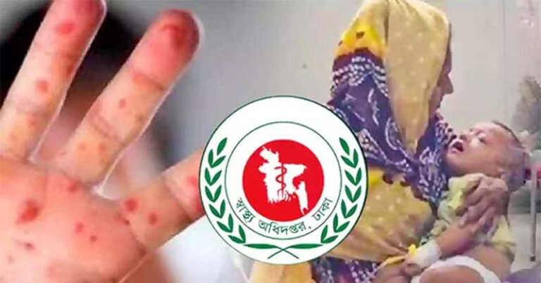 একদিনে হাম উপসর্গ নিয়ে আরও ৮ শিশুর মৃত্যু