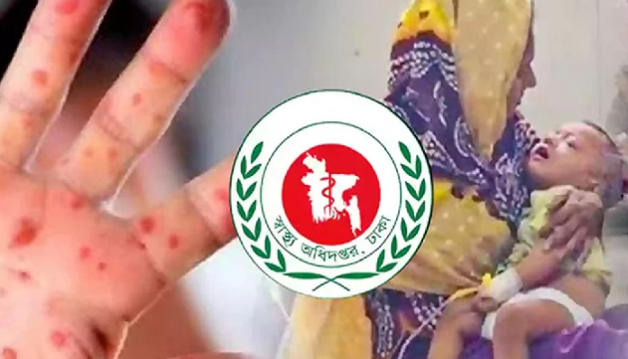 ২৪ ঘণ্টায় হাম উপসর্গে দুইজনের মৃত্যু, নতুন আক্রান্ত ১০৮৫